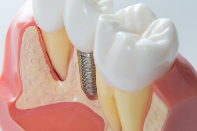 Close up of a Dental implant model. Selective focus.