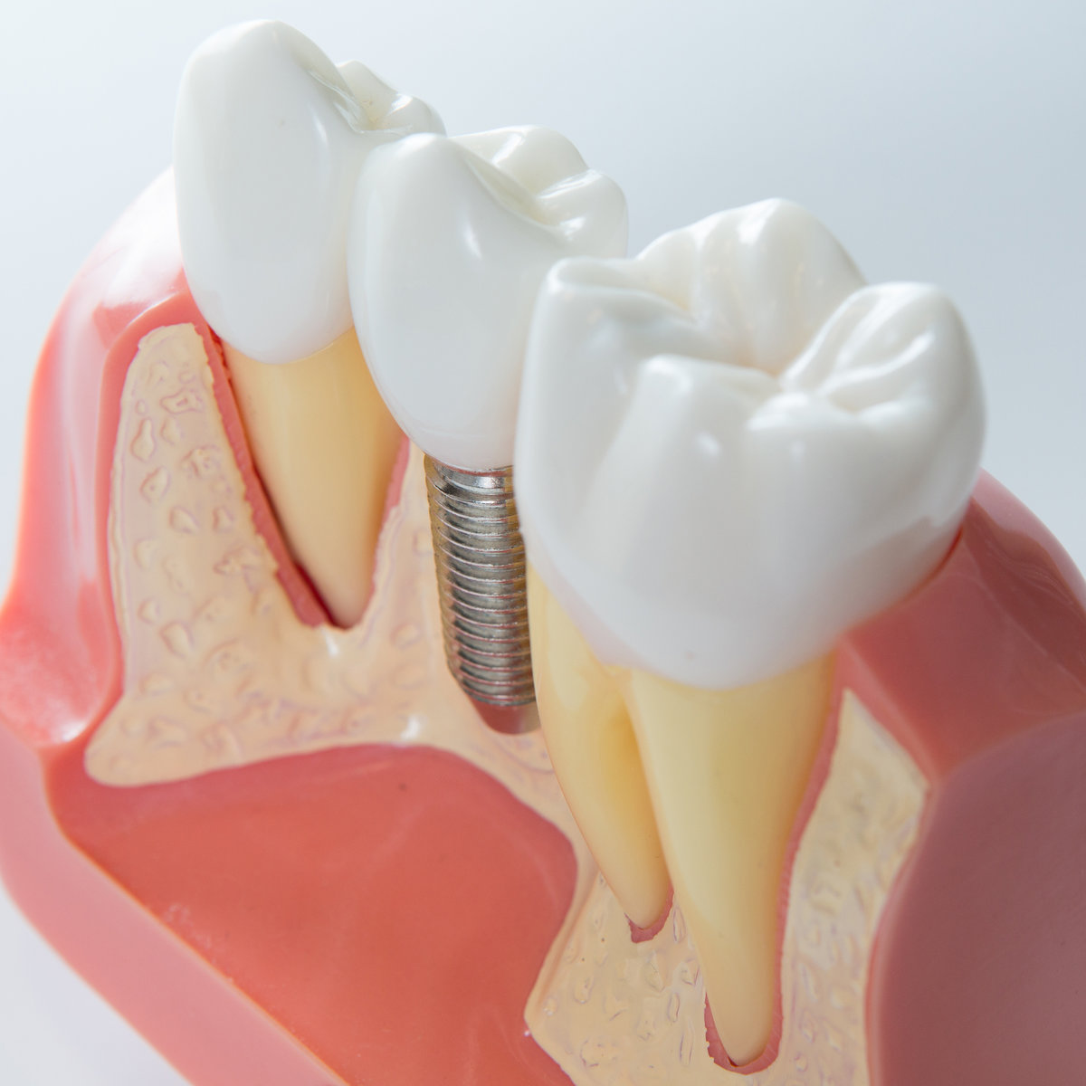 How Bone Grafting Works and Why It’s Sometimes Needed Before Implants