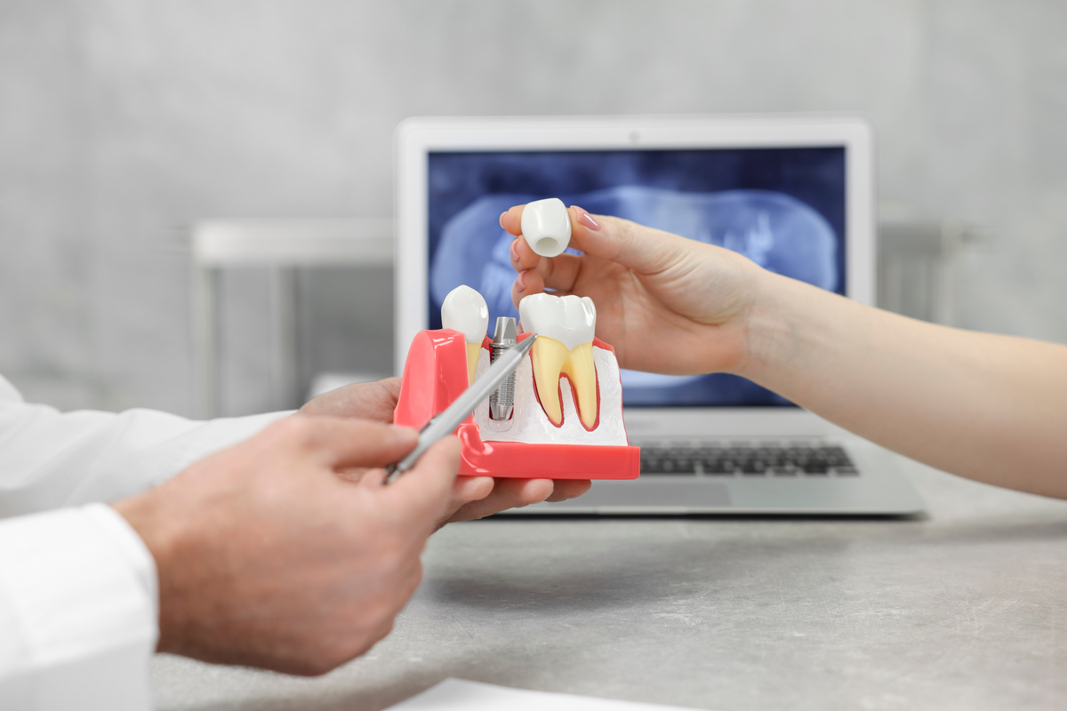 Immediate Implants: Can You Get a Tooth Replaced the Same Day?