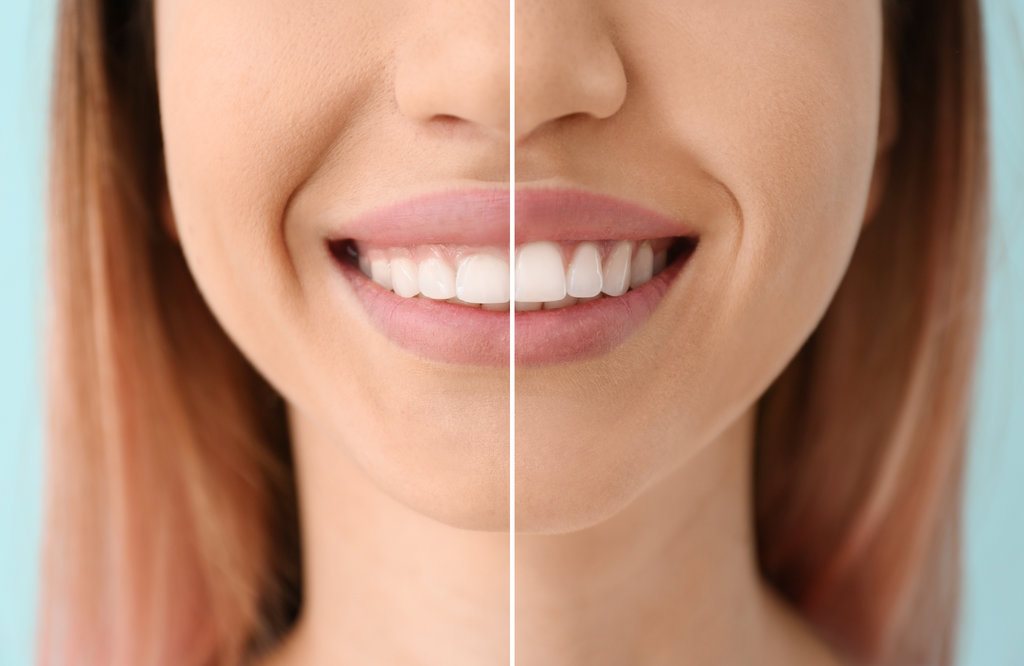 What Is Gum Contouring and Who Is It For?