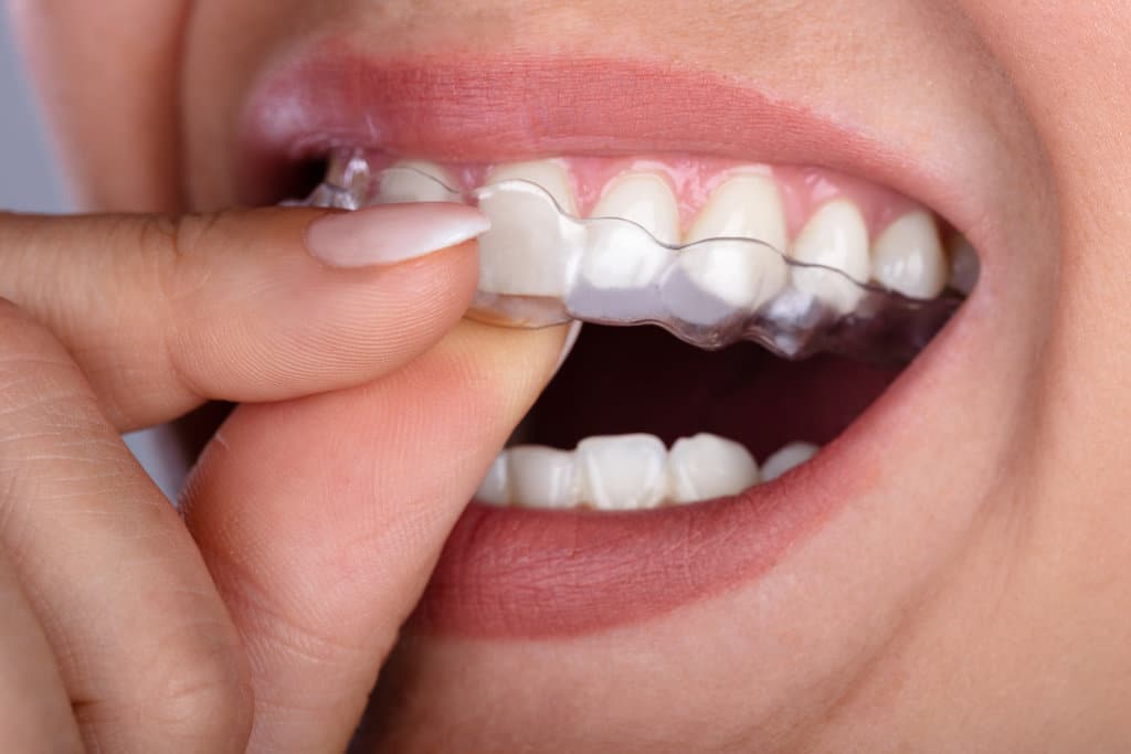 Can Clear Aligners Fix an Overbite or Underbite?
