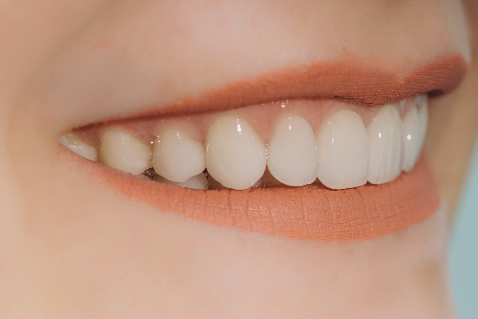 What Is the Difference Between a Crown and a Veneer?